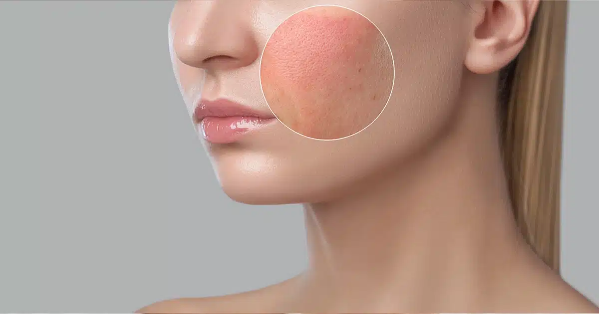 Skin Irritation | त्वचेवरील जळजळ दूर करण्यासाठी वापरा 'हे' घरगुती उपाय