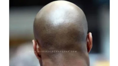 Hair loss । बापरे! राज्यात विचित्र आजाराचे थैमान, खाज येऊन तीनच दिवसात पडतोय टक्कल; नेमकं कारण काय? Hair loss । बापरे! राज्यात विचित्र आजाराचे थैमान, खाज येऊन तीनच दिवसात पडतोय टक्कल; नेमकं कारण काय?